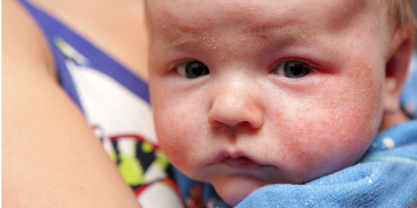 A Parents Guide to Baby Eczema Parenting Advice